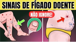 10 SINAIS de PROBLEMA no FÍGADO na PELE  Sintomas de GORDURA NO FÍGADO CIRROSE e HEPATITE [upl. by Trudey702]