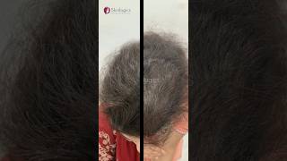 GFC treatment for Hair Growth gfctherapy hairloss hairgrowth shorts skinlogicsclinic [upl. by Saberio]