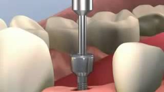 Simulación 3d colocacion de implantes [upl. by Llerraj685]