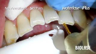 BIOLASE WaterLase iPlus Incisal Cavity Preparation [upl. by Kimbra432]