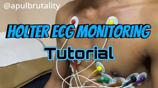 Holter ECG monitoring tutorial  placement recording and interpretation [upl. by Ayotak]