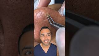 OMG I was not expecting that blackhead extraction on the nose Dr Somji reacts [upl. by Ibbob]