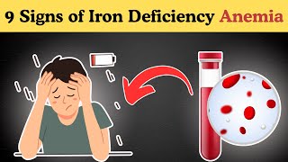 Iron Deficiency ALERT Stop Ignoring These 9 Warning Signs [upl. by Dearr]