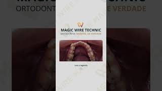 Técnica Magic Wire — Ortodontia Invisível de Verdade [upl. by Aninad624]