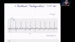 Quick Junctional Rhythms Review Paramedic Cardiology [upl. by Aihtnys]