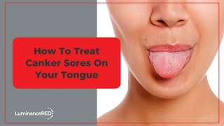 How to Treat Canker Sores on Your Tongue [upl. by Pond]