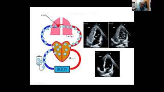 Lung Arteriovenous Malformations AVMs and Hereditary Hemorrhagic Telangiectasia HHT [upl. by Akiam]