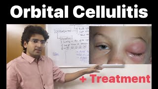 Orbital Cellulitis Pathology Clinical features and Treatment [upl. by Olegnaed]