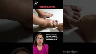 Pitting Edema Health Assessment SHORT  LevelUpRN [upl. by Elleinod957]