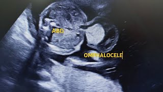 Omphalocele in ultrasound Usg [upl. by Erminie579]