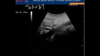 Aorta abdominal Tronco celiaco y arteria mesetérica superior PD H12OCT [upl. by Fronnia]