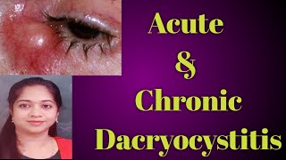 Dacryocystitis  Acute dacryocystitis Chronic Dacryocystitis Stages of Dcryocystitis Mucocele [upl. by Cirnek]