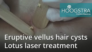 Eruptive vellus hair cysts  Lotus laser treatment 20234 [upl. by Jelena710]