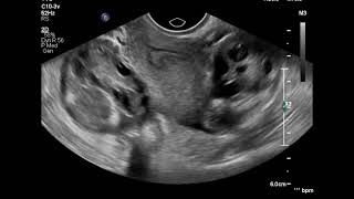 Bilateral salpingitis ultrasound [upl. by Nevanod639]