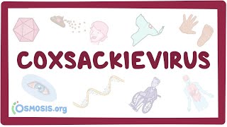 Coxsackievirus  an Osmosis Preview [upl. by Eidson]