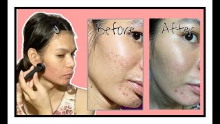 Microneedling Before and After  Q and A  Derma Pen vs Derma Stamp [upl. by Woodward277]