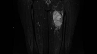 Myxofibrosarcoma grade 3 [upl. by Tatia230]