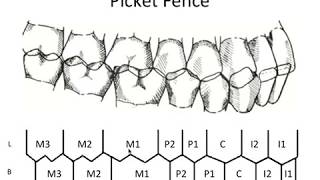 STATIC OCCLUSION  Occlusal Contacts amp Picket Fence [upl. by Eeliak550]