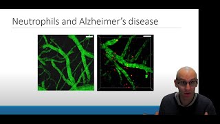 Neuroinflammation in Alzheimers Disease The Role of Neutrophils [upl. by Dincolo]