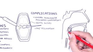 Acute Tonsillitis  causes viral bacterial pathophysiology treatment tonsillectomy [upl. by Sregor]