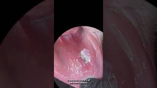 A new way to treat canker sores aphthous ulcers dentalhygiene dentalpain cankersores [upl. by Dareg]