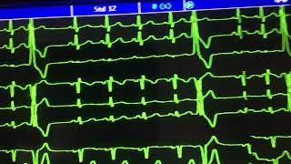 EXTRASISTOLES VENTRICULARES UNIFOCALES FRECUENTES EN TRAZO ELECTROCARDIOGRAFICO DE MONITOR ♥️ [upl. by Rehnberg]