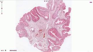 Condyloma  Histopathology [upl. by Nett]