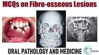 bone dysplasia 1 quotfibro osseous lesionsquot  oral pathology  عزت شومان [upl. by Lowrance]