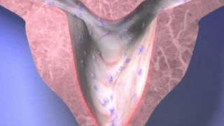 HTA Endometrial Ablation for Menorrhagia [upl. by Oyek]