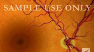 Eye Retinal Artery Damage [upl. by Eladnek]