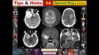 Sphenoid wind lesions DD Tips amp Hints 14 [upl. by Colyer]