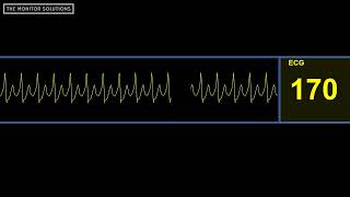 Supraventricular Tachycardia SVT Rhythm Waveform  Simulated Patient Waveform [upl. by Ralf]