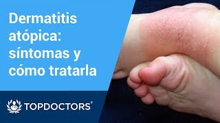 Tratamiento recomendado para la dermatitis atópica 55 [upl. by Llednik]