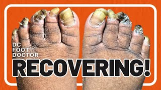 Recovering Trimming Fungal Toenails [upl. by Yk]