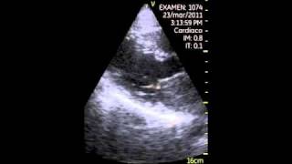 VSCAN left atrial tumor atrial myxoma pocket ultrasound [upl. by Sisto771]