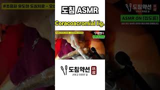 ACUPOTOMY ASMR Coracoacromial ligament  오구견봉인대 초음파 도침치료 [upl. by Asilav322]