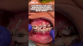 Reality of Dental Braces Treatment that All Patients Should Know  braces dentalbraces shorts [upl. by Verna]