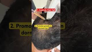 Effects of PRP in Hair Loss shorts hairfall hairtransplant hair [upl. by Towers569]