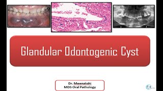 Glandular Odontogenic Cyst [upl. by Aitat]