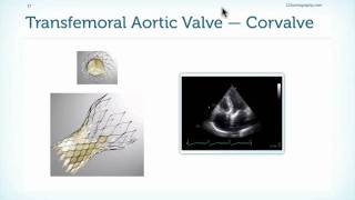 Assessment of Prostheses in Echocardiography [upl. by Haynes808]