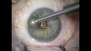 Alcohol debridement and diamond burr for recurrent corneal erosions [upl. by Yntruoc899]