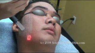 Laser Acne Scar Removal Filipino Male [upl. by Adnohsal]