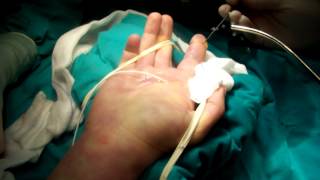 Flexor Tendon Sheath WashoutMOV [upl. by Catina831]