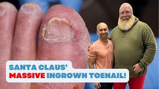 SANTA CLAUS has a MASSIVE INGROWN TOENAIL [upl. by Aviv]