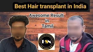 Hair Transplant result in Tamil  Awesome result  besthairtransplantinsouthindia hsn [upl. by Duax]