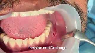 Incision and Drainage of Tooth Abscess Draining Pus [upl. by Ydarg188]