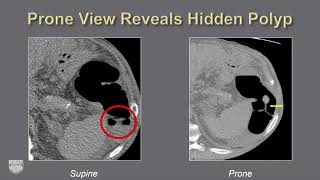 Tumor Imaging CT Colonography  Course Sample [upl. by Muriah]