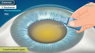 Cataract  Types  Clinical features  Diagnosis Treatment  Amblyopia  Complications [upl. by Ij21]