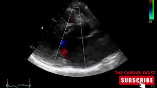 Hypertrophic Cardiomyopathy  SAM  MR [upl. by Gibrian]