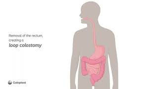 Anatomy of Loop Colostomy Creation [upl. by Atteuqal]